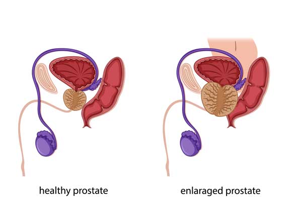 Porstate